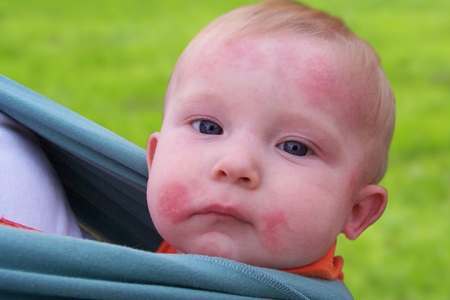 Treating Ringworm in Infants