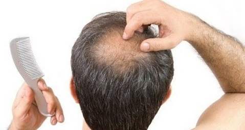 Get Rid Of Ringworm Of The Scalp