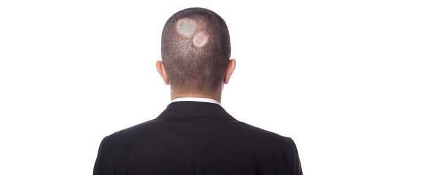 Get Rid Of Ringworm Of The Scalp